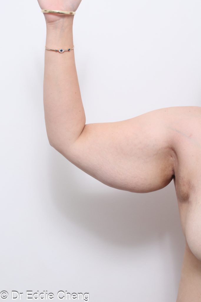 Before and after arm lift (brachioplasty) by Dr Eddie Cheng Brisbane.