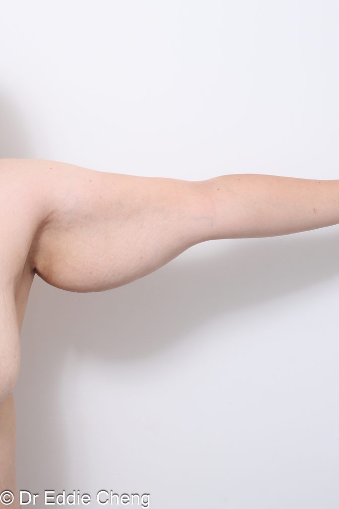 Before and after arm lift (brachioplasty) by Dr Eddie Cheng Brisbane.