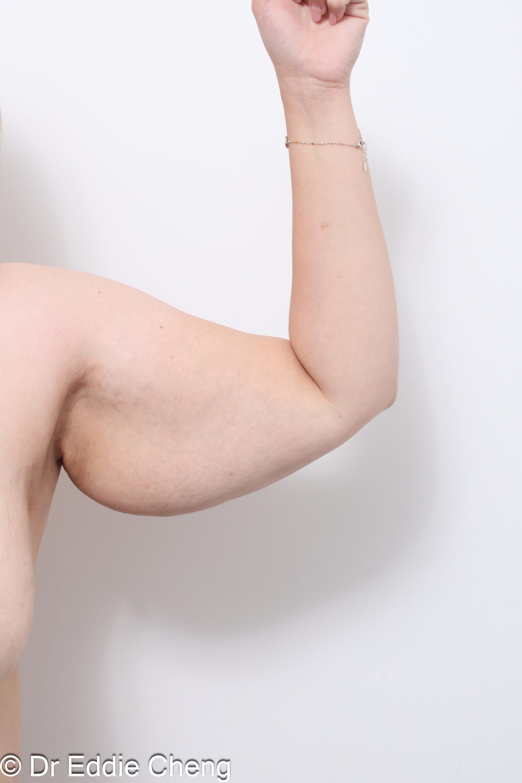 Before and after arm lift (brachioplasty) by Dr Eddie Cheng Brisbane.