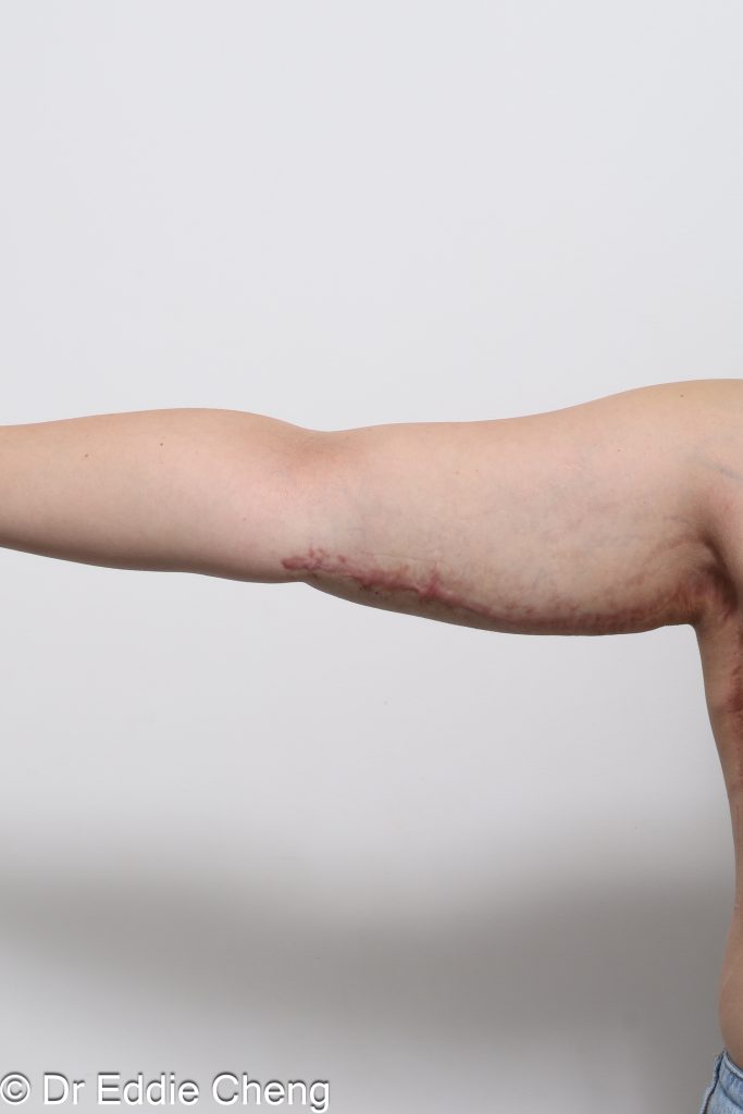 Before and after arm lift (brachioplasty) by Dr Eddie Cheng Brisbane.