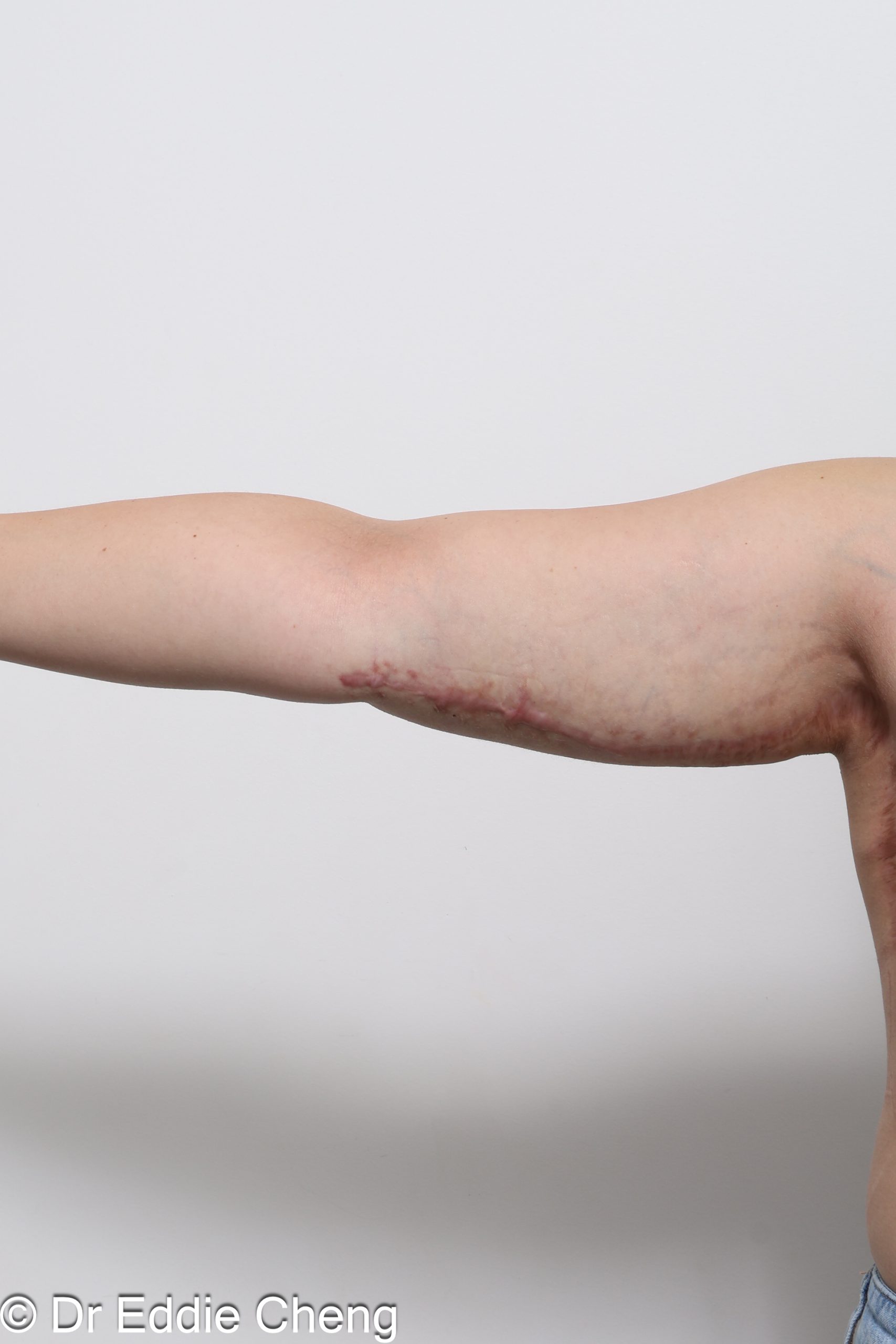 Before and after arm lift (brachioplasty) by Dr Eddie Cheng Brisbane.