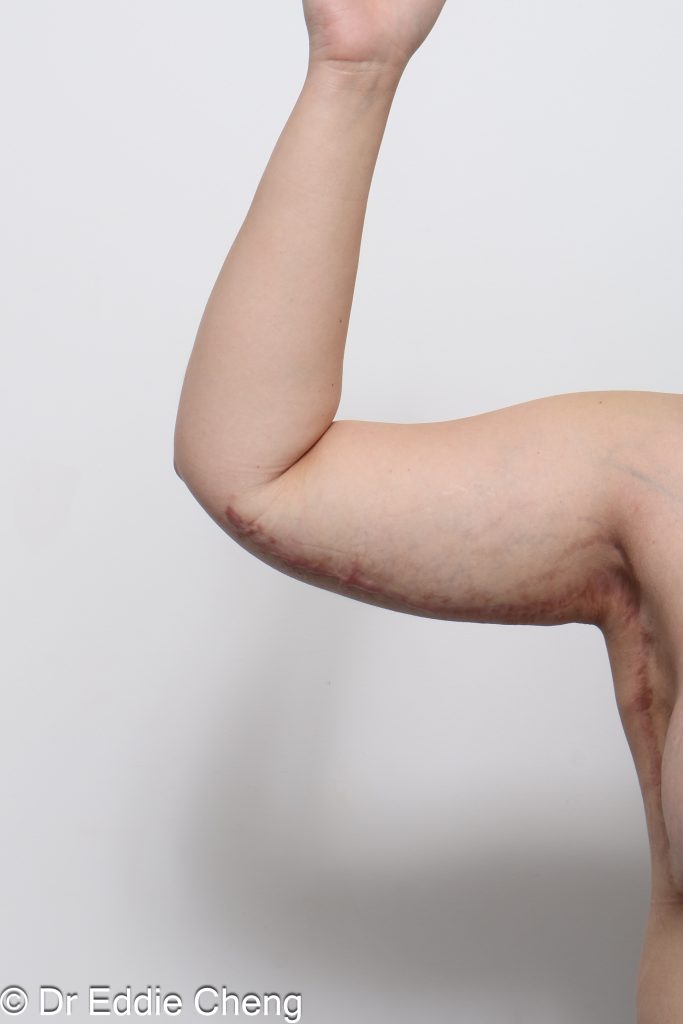 Before and after arm lift (brachioplasty) by Dr Eddie Cheng Brisbane.