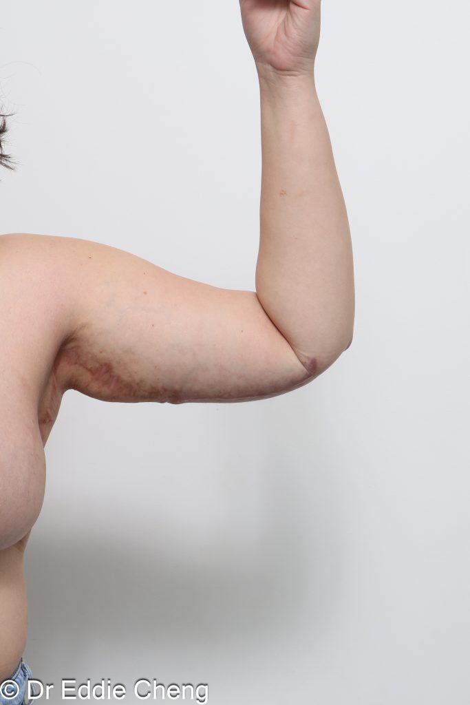 Before and after arm lift (brachioplasty) by Dr Eddie Cheng Brisbane.