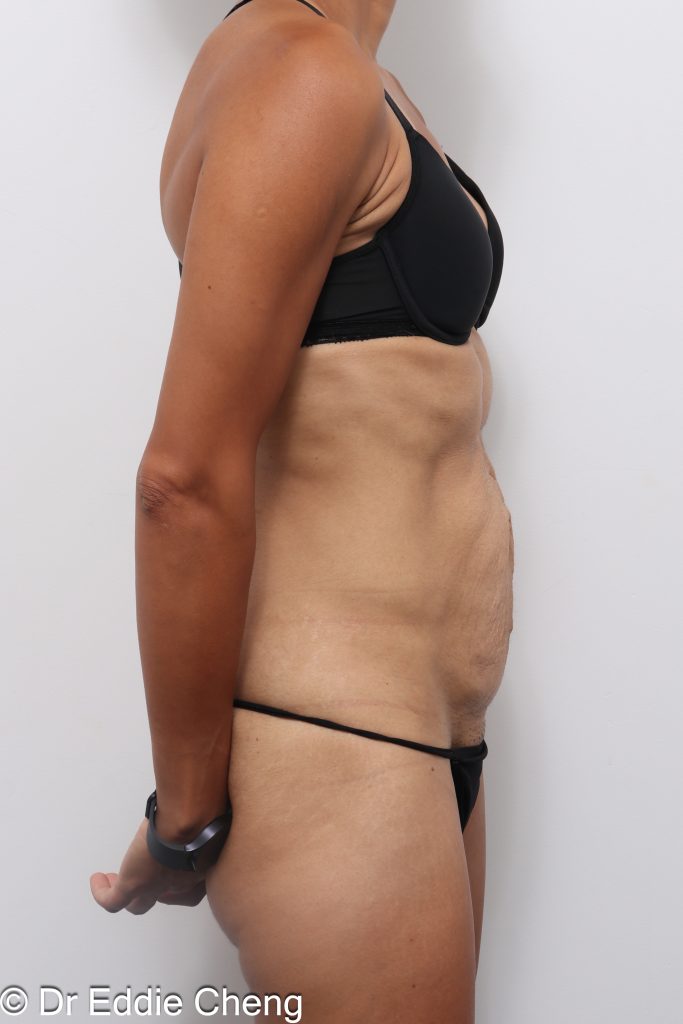 Before and after abdominoplasty with repair of muscle separation postpartum by Dr Eddie Cheng Brisbane
