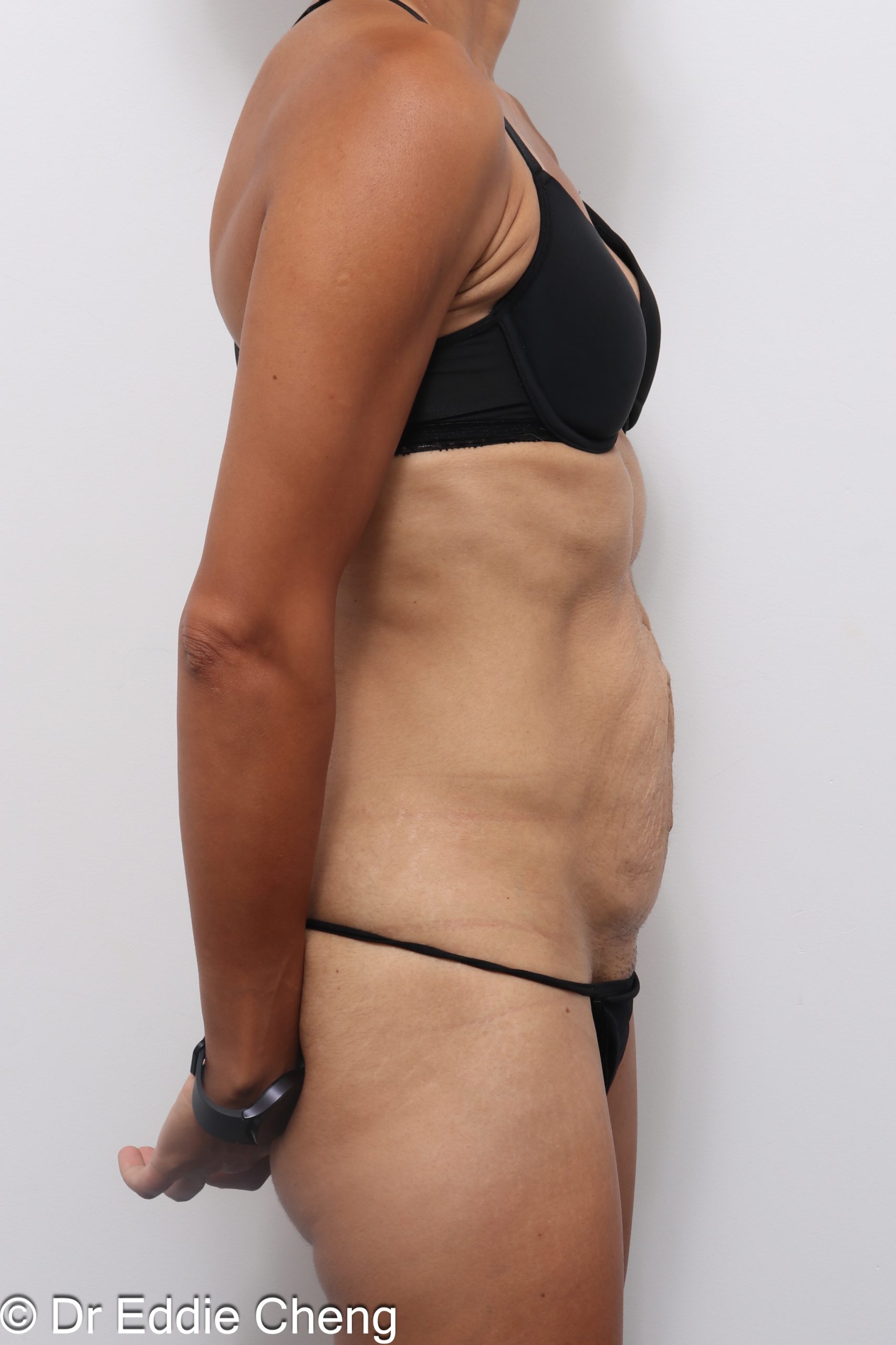 Before and after abdominoplasty with repair of muscle separation postpartum by Dr Eddie Cheng Brisbane