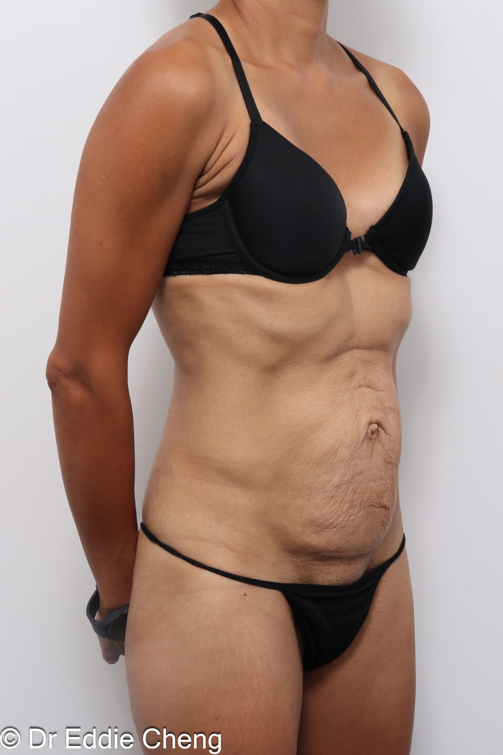 Before and after abdominoplasty with repair of muscle separation postpartum by Dr Eddie Cheng Brisbane