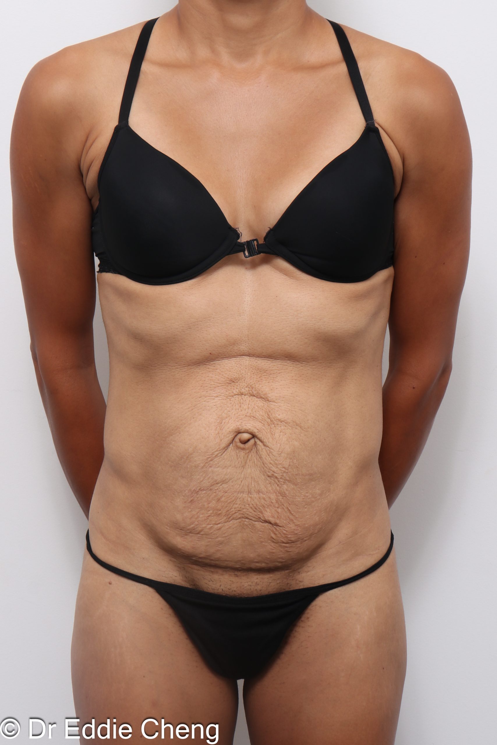Before and after abdominoplasty with repair of muscle separation postpartum by Dr Eddie Cheng Brisbane