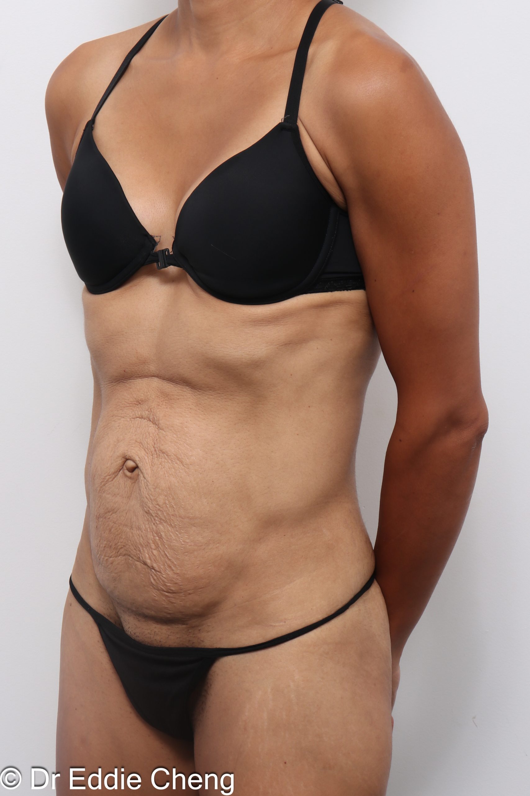 Before and after abdominoplasty with repair of muscle separation postpartum by Dr Eddie Cheng Brisbane