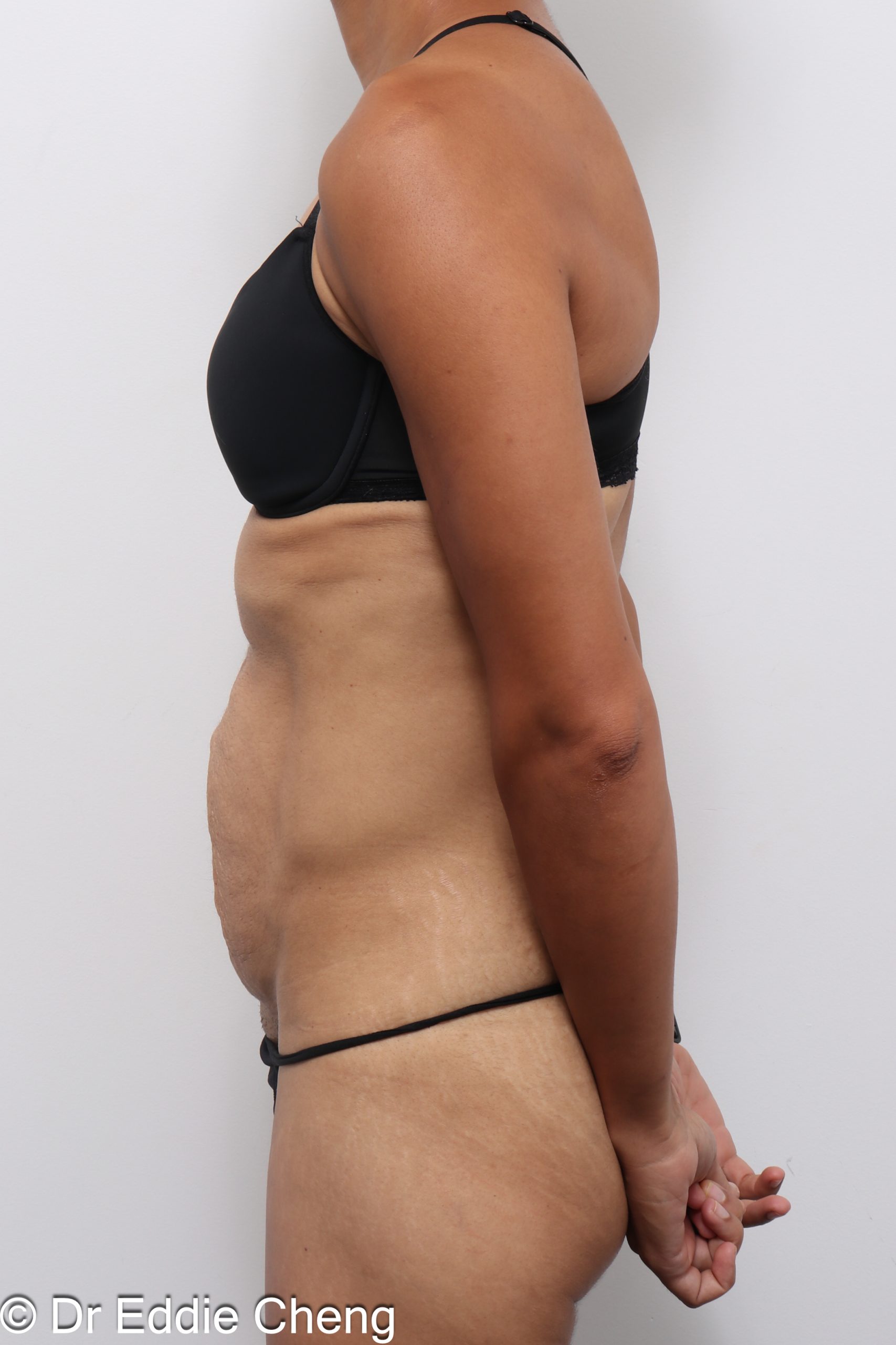 Before and after abdominoplasty with repair of muscle separation postpartum by Dr Eddie Cheng Brisbane