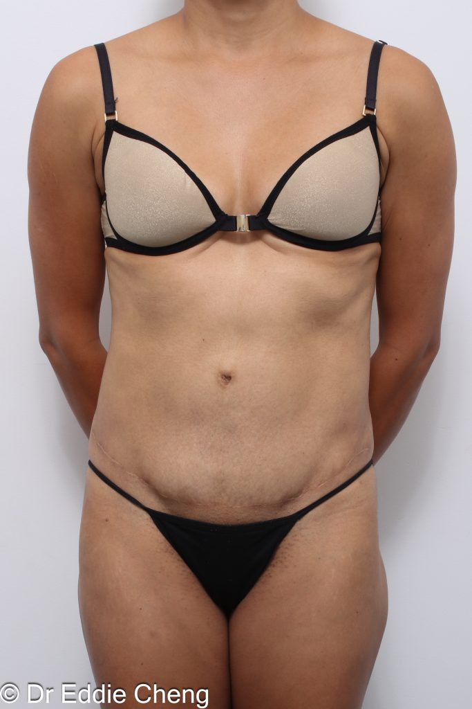Before and after abdominoplasty with repair of muscle separation postpartum by Dr Eddie Cheng Brisbane