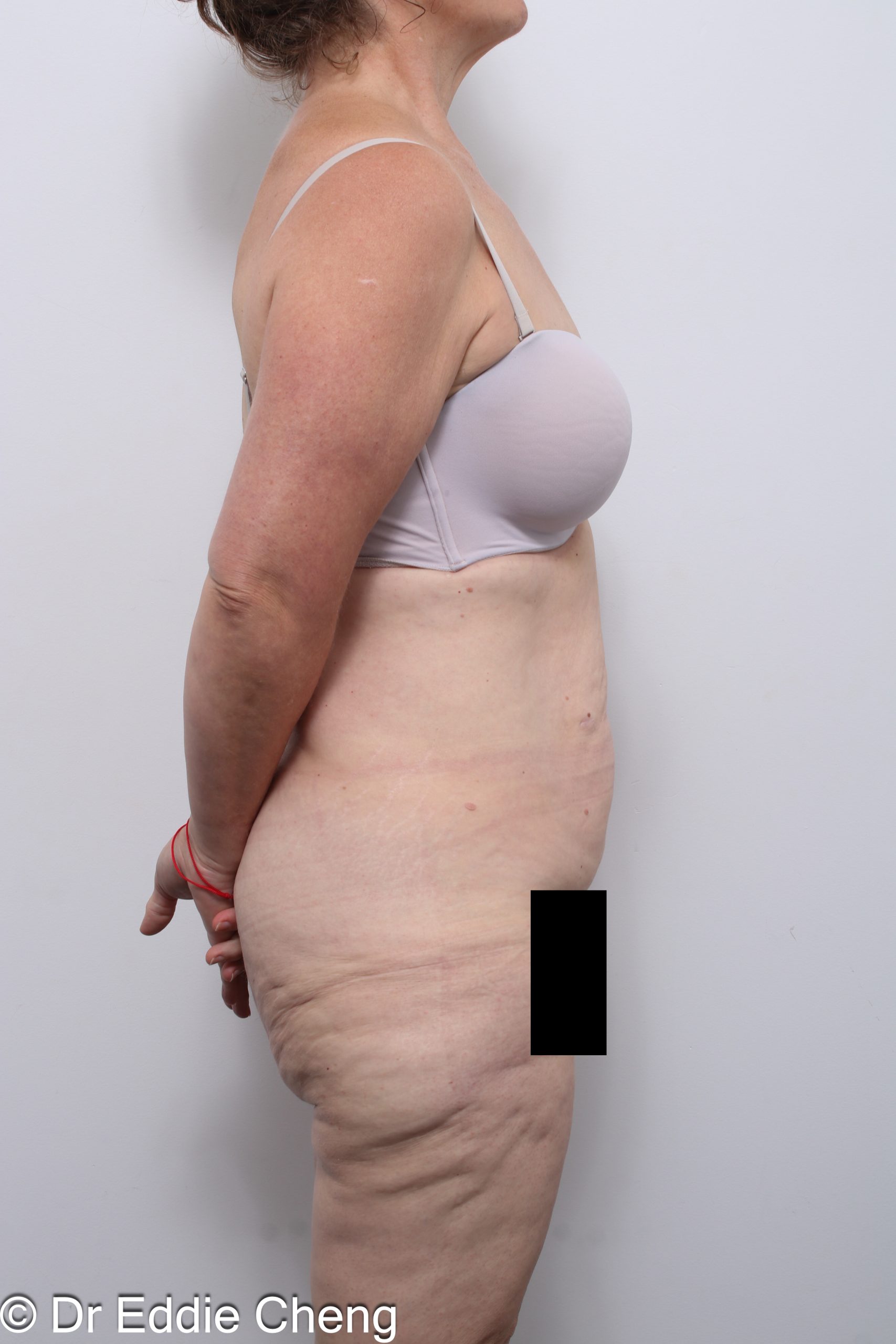 lower body lift or belt lipectomy by Dr Eddie Cheng Brisbane