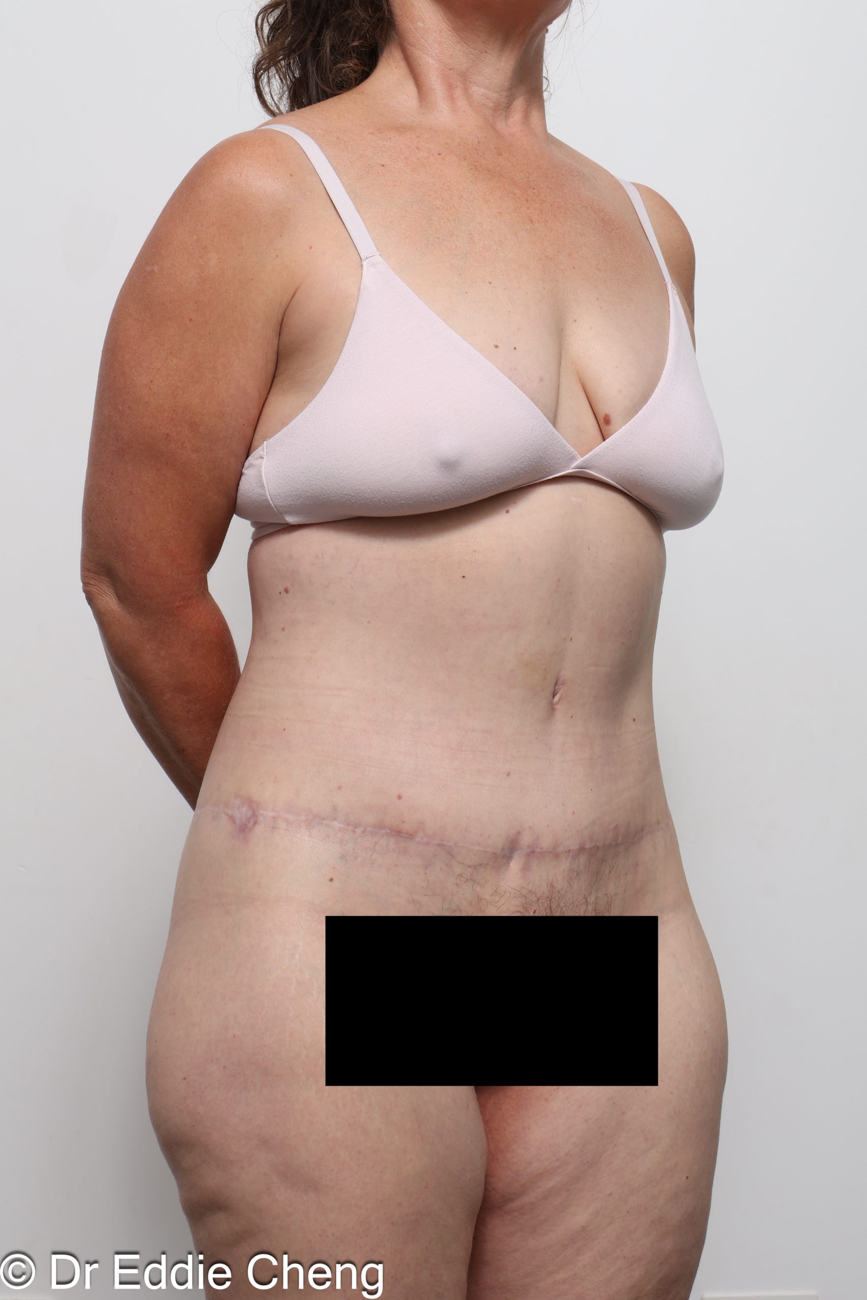 lower body lift or belt lipectomy by Dr Eddie Cheng Brisbane