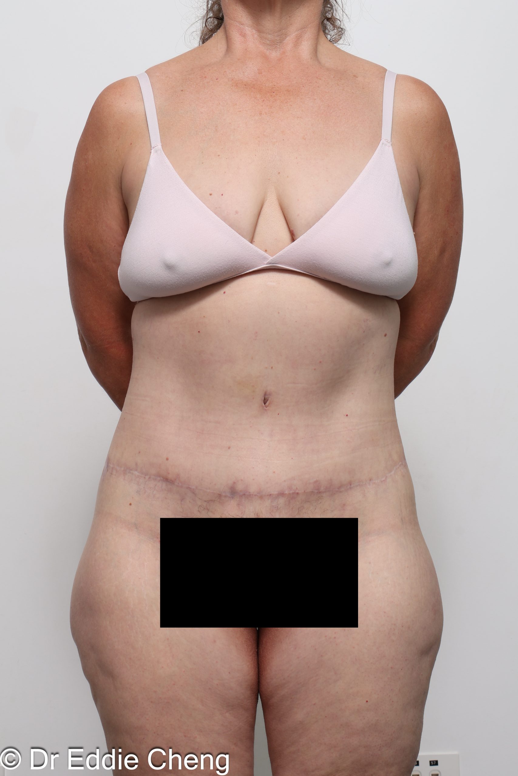 lower body lift or belt lipectomy by Dr Eddie Cheng Brisbane