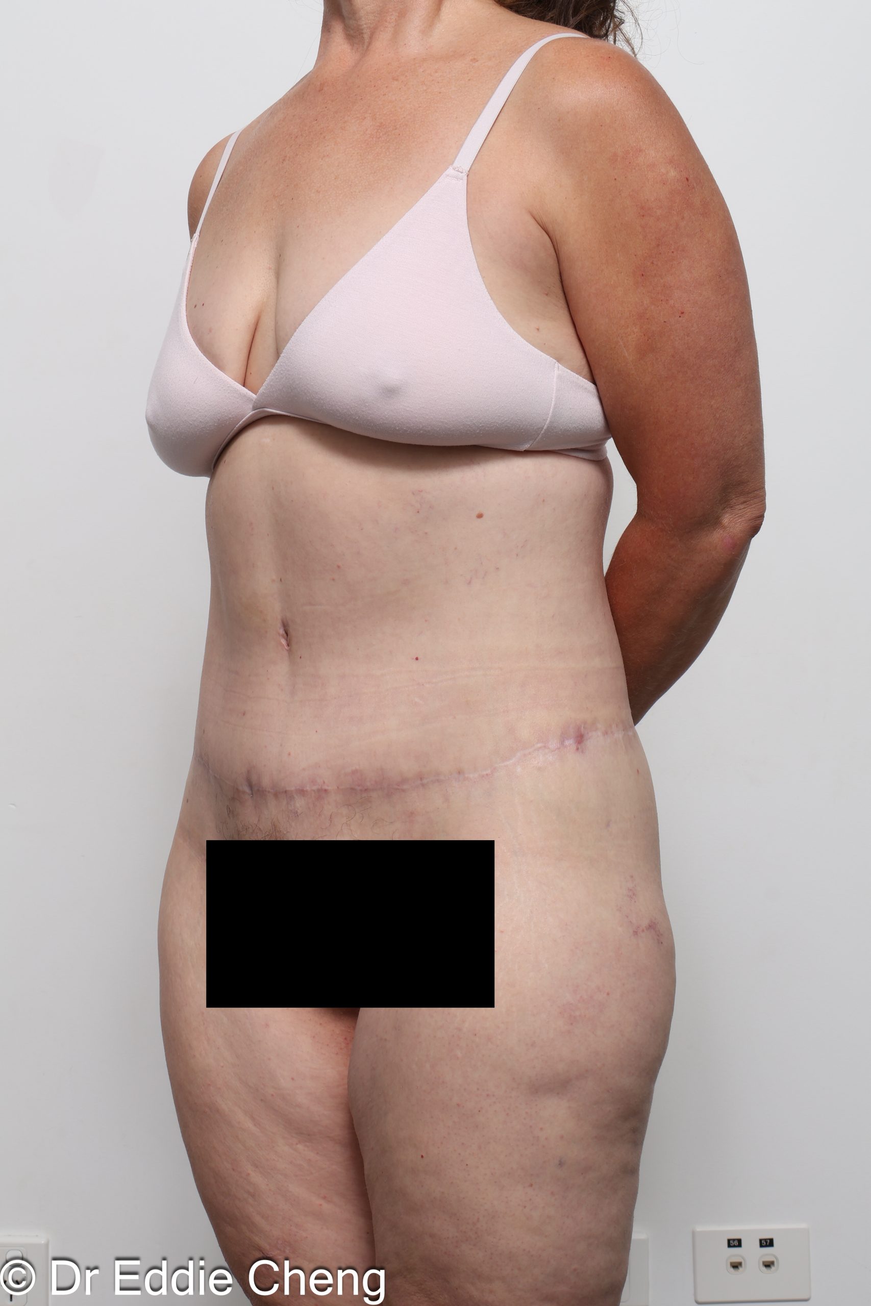 lower body lift or belt lipectomy by Dr Eddie Cheng Brisbane