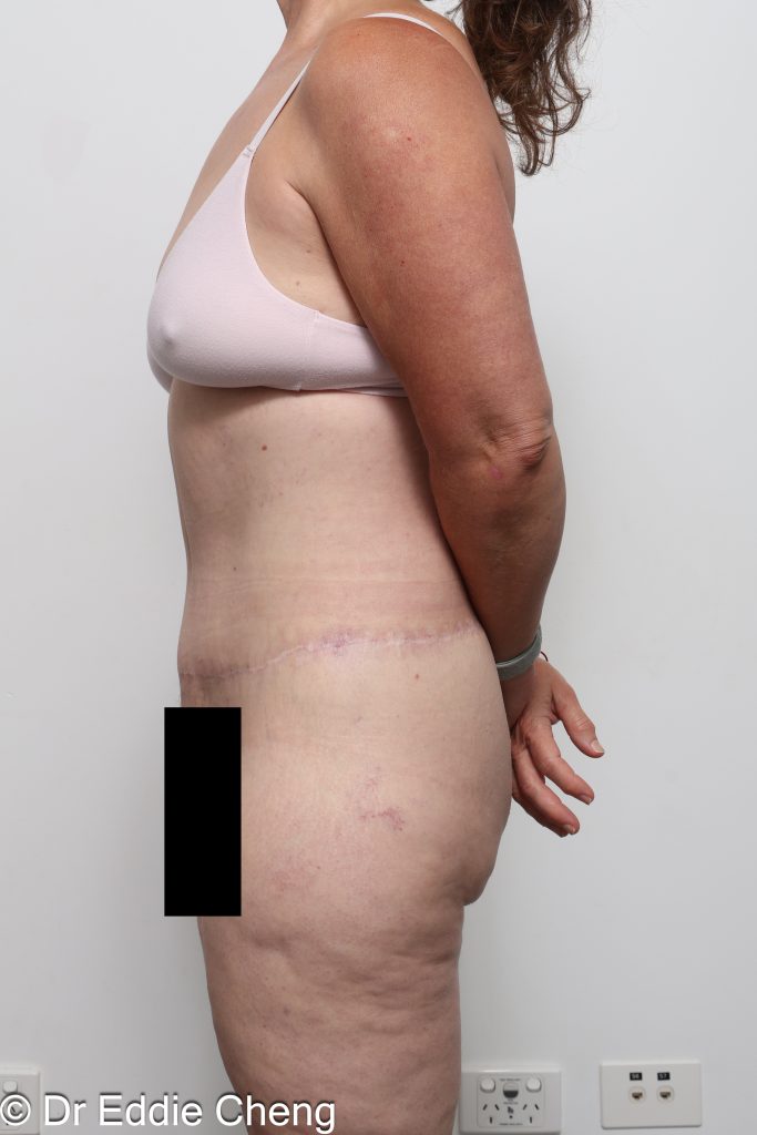 lower body lift or belt lipectomy by Dr Eddie Cheng Brisbane
