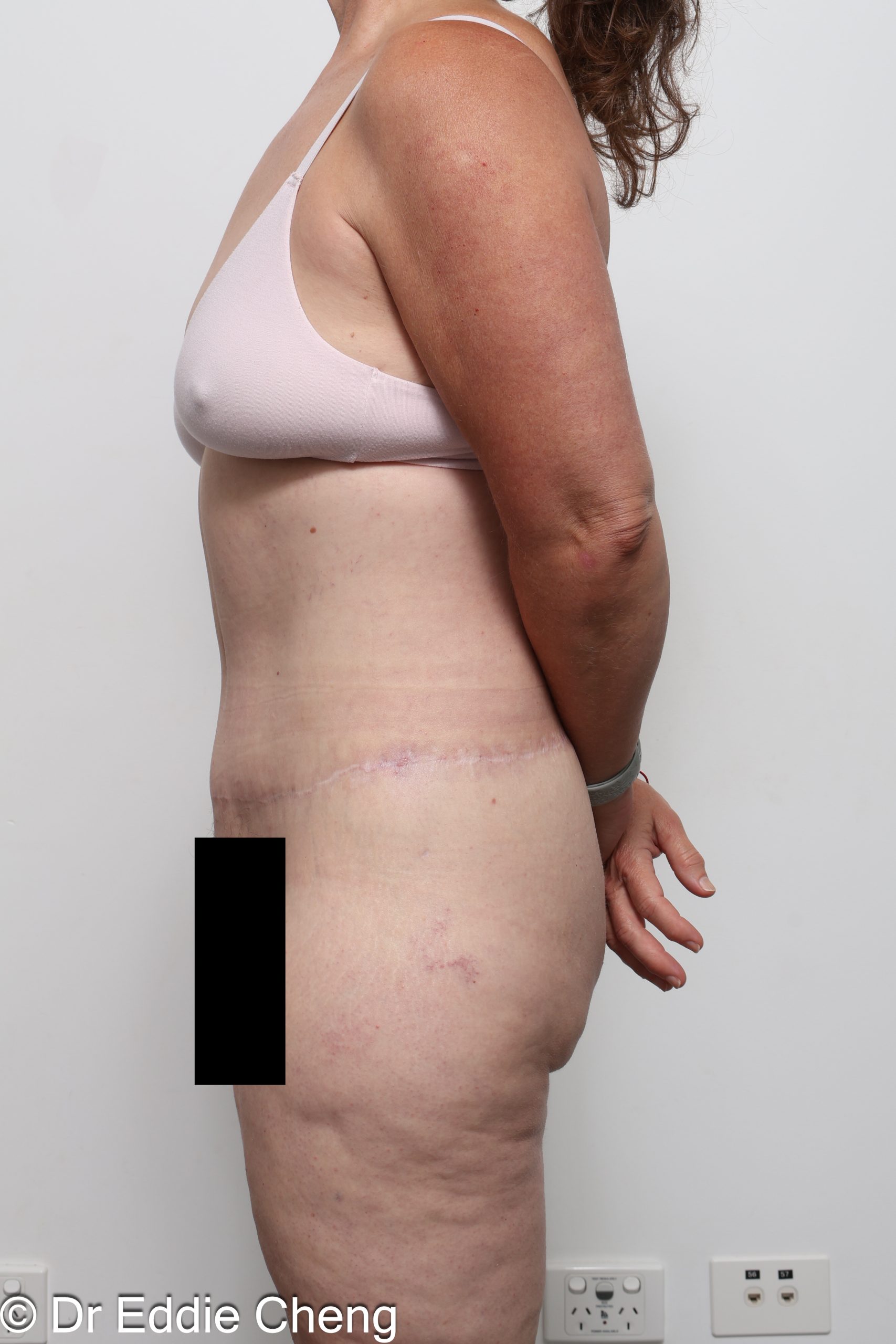 lower body lift or belt lipectomy by Dr Eddie Cheng Brisbane