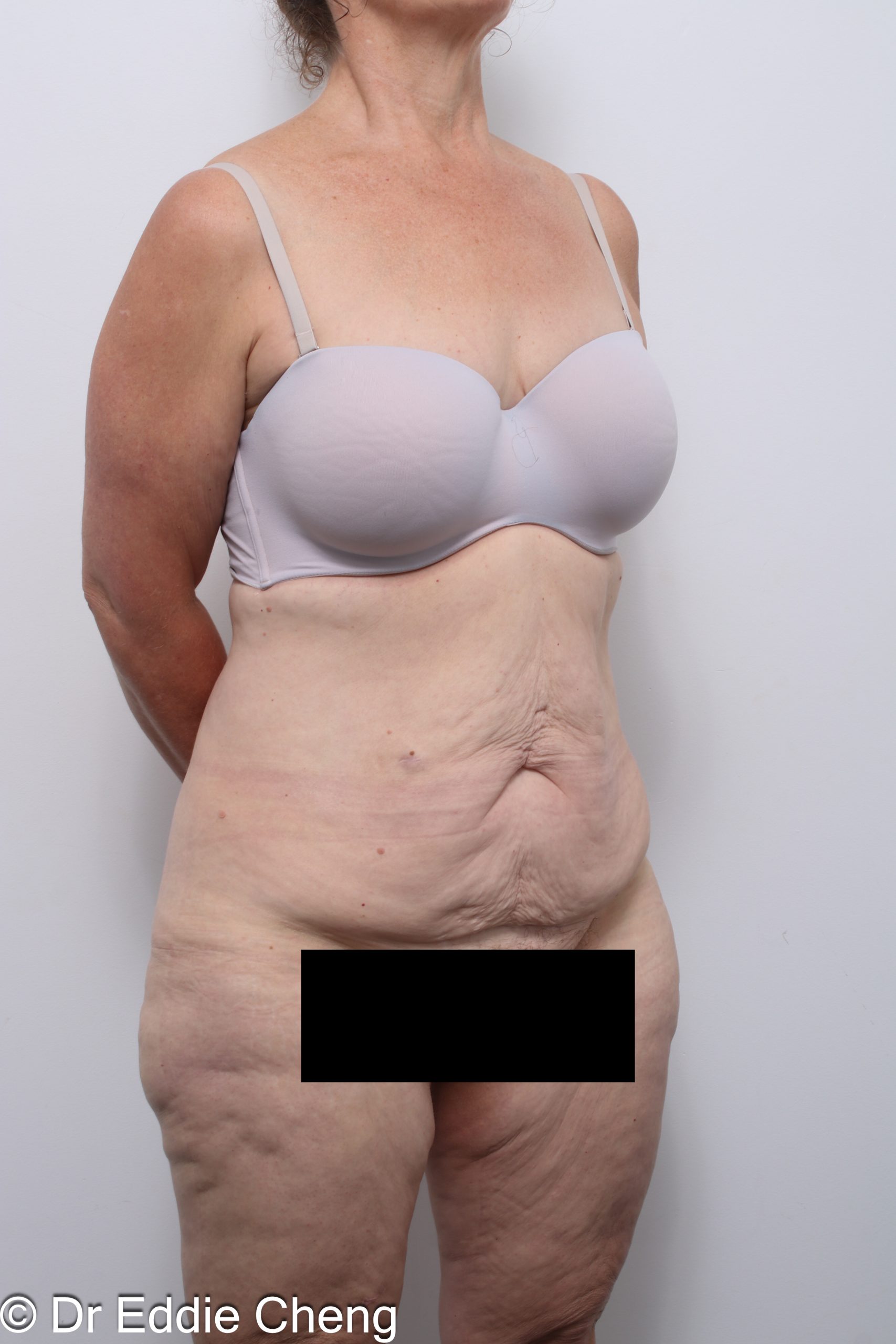 lower body lift or belt lipectomy by Dr Eddie Cheng Brisbane