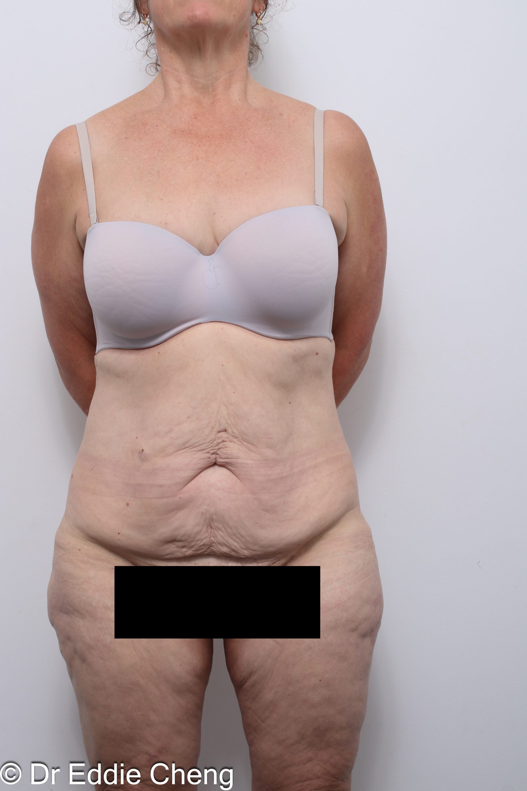 lower body lift or belt lipectomy by Dr Eddie Cheng Brisbane