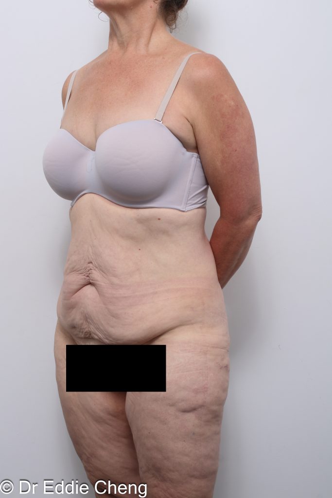 lower body lift or circumferential lipectomy by Dr Eddie Cheng Brisbane