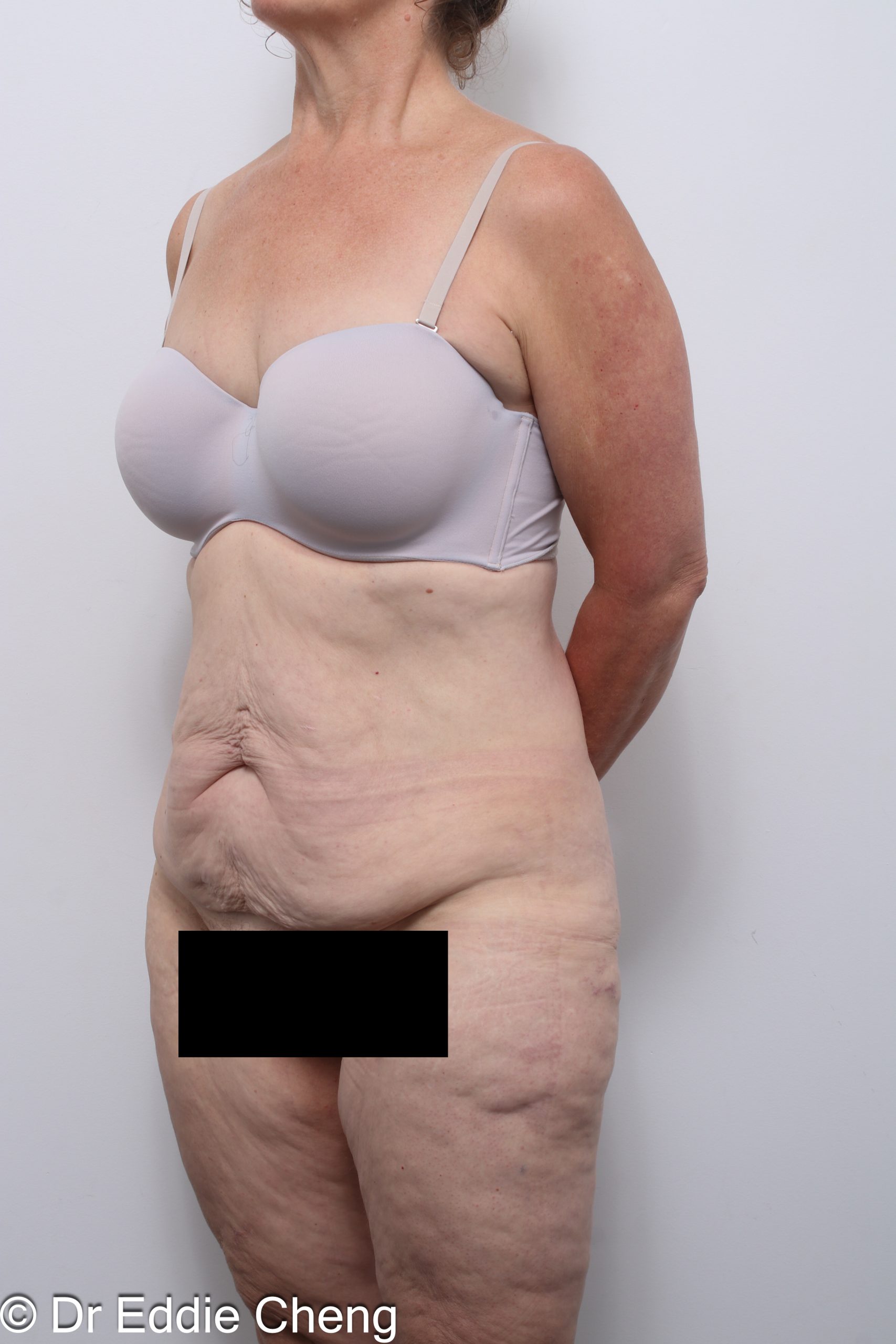 lower body lift or circumferential lipectomy by Dr Eddie Cheng Brisbane