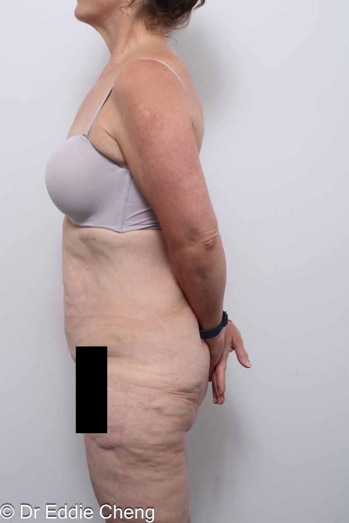 lower body lift or belt lipectomy by Dr Eddie Cheng Brisbane