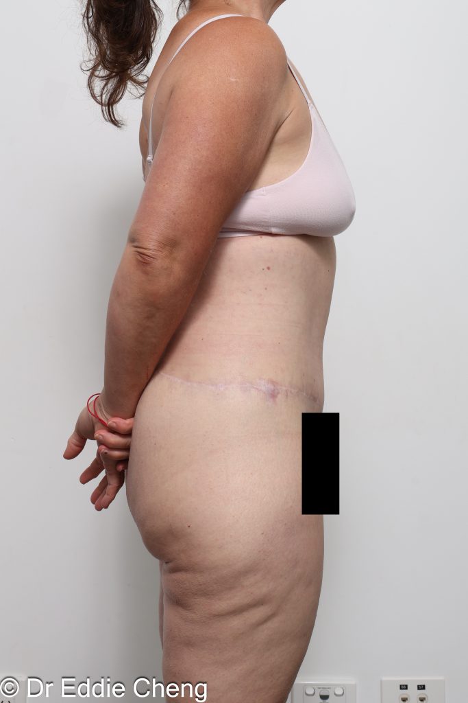 lower body lift or belt lipectomy by Dr Eddie Cheng Brisbane